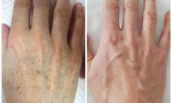 Lumenis M22 лазерное удаление пигментации кисти рук Косметологічний центр Beauty Laser & EndoSpheres Therapy Київ