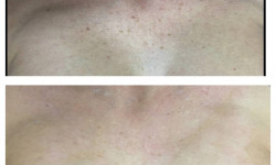 Lumenis M22 лазерное удаление пигментации декольте Косметологічний центр Beauty Laser & EndoSpheres Therapy Київ