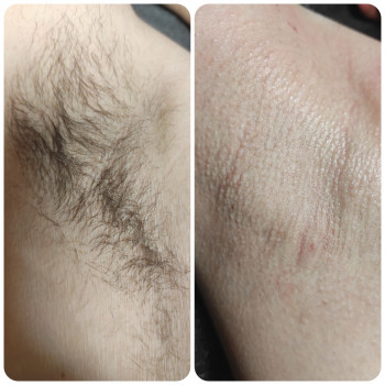 Шугаринг
                    Майстер депіляції Маргарита Харків