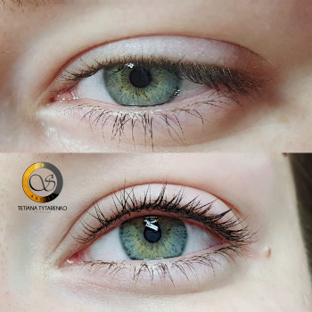 Межресничный прокрас век