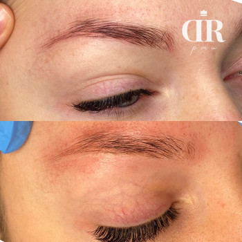 Лазерное удаление бровей. 1 процедура