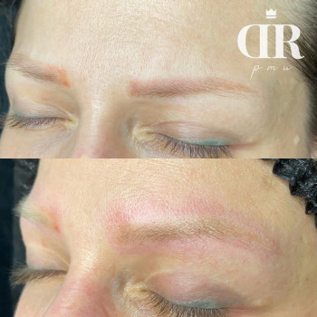 Лазерное удаление бровей пикосекундным лазером нового поколе