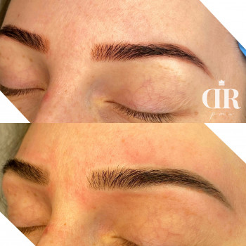 Лазерное удаление бровей. Одна процедура
