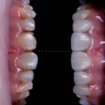 Художня реставрація, фото - стоматолог Вепа Джумаев
