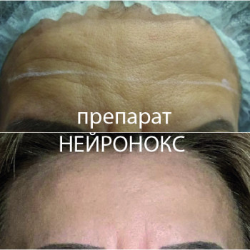 Ботокс в лоб
                    Косметолог-ін'єкціоніст Елена Київ