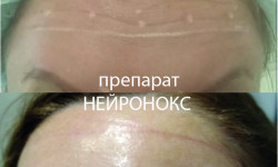 Ботокс 4 зоны: лоб, межбровье, вокруг глаз, нос Косметолог-ін'єкціоніст Елена Київ