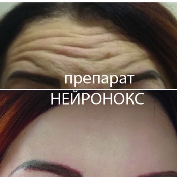 Ботокс 4 зоны: лоб, межбровье, вокруг глаз, нос
                    Косметолог-ін'єкціоніст Елена Київ