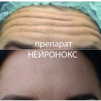 Ботокс 4 зоны: лоб, межбровье, вокруг глаз, нос
                    Косметолог-ін'єкціоніст Елена Київ