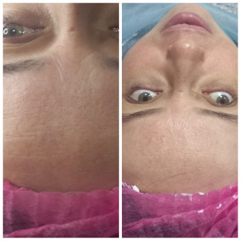 Карбоксітерапія
                    Косметолог Лілія Вінниця