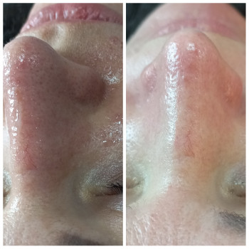 Чистка обличчя + Альгінатна маска у подарунок!
                    Косметолог Лілія Винница