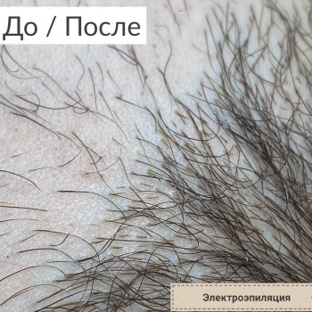 Результат после одной процедуры Электроэпиляции