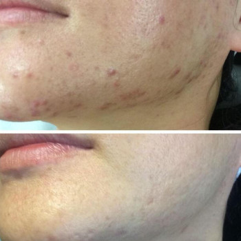 Мезотерапия
                    Косметолог Анастасия Одеса