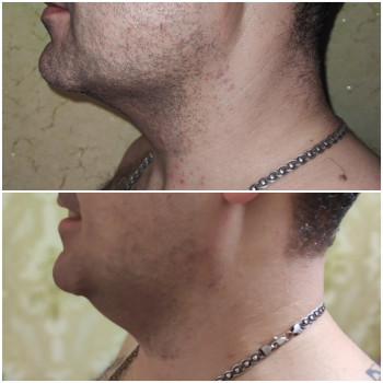 Липолитики.Коррекция второго подбородка