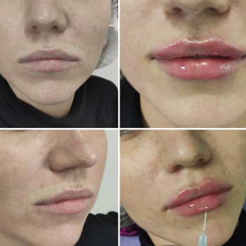 Увеличение губ.
Техника "парижские губки"