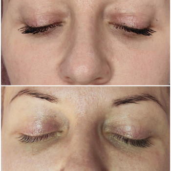 Коррекция носослезной борозды