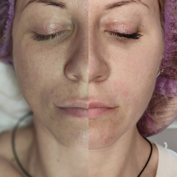 Массаж лица.