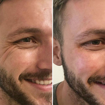 Ботулинотерапия зоны вокруг глаз