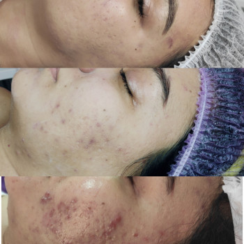 Лечение акне пилингами