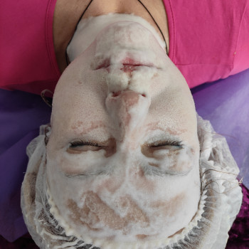 Карбокситерапия