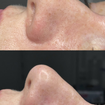 Комбинированная чистка лица
                    Дерматолог косметолог Анна Одеса