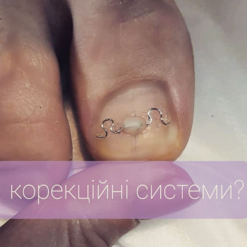 вросший ноготь, лечение ногтей на ногах
