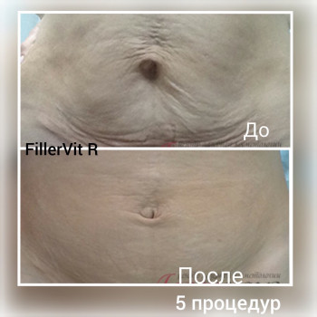 Мезотерапия подтяжка кожи