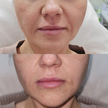 Нитевой лифтинг