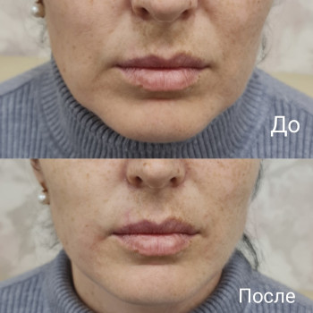 Нитевой лифтинг