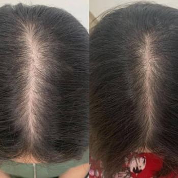 Lumenis M22 Лечение облысения ResurFX Hair