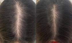 Lumenis M22 Лечение облысения ResurFX Hair Вся голова Косметологический центр Beauty Laser & EndoSpheres Therapy Киев