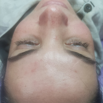 Комбінована чистка обличчя