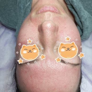 Фракційна мезотерапія