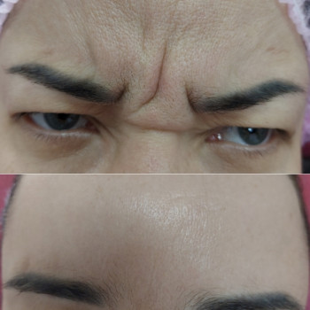 Ботулинотерапия межбровья