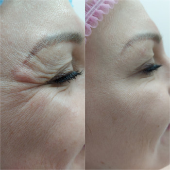 Ботулинотерапия орбитальной зоны