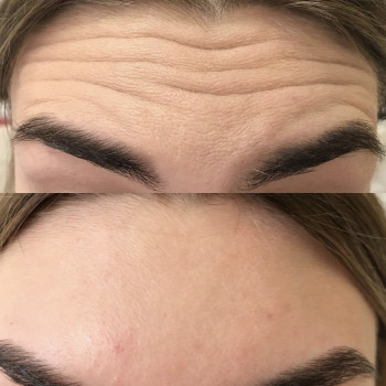 Ботулинотерапия лба