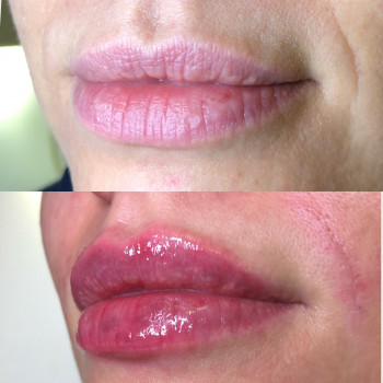 Контурная пластика губ