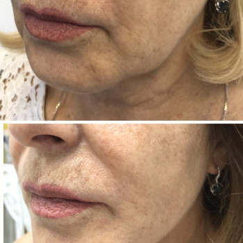 Нитевой лифтинг Aptos