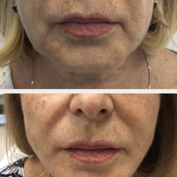 Нитевой лифтинг Aptos