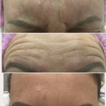 Ботулинотерапия