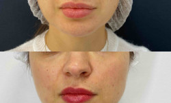 Smas ліфтинг Ultraformer III Косметологічний центр MD Aesthetic Clinic Київ