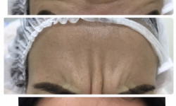 Ботулінотерапія Косметологический центр MD Aesthetic Clinic Киев