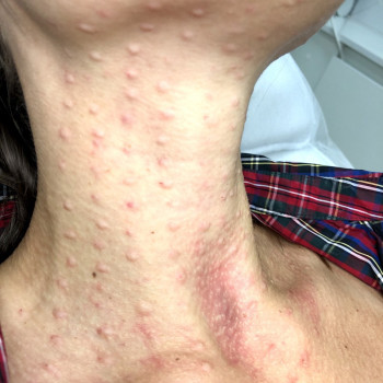 Биоревитализация