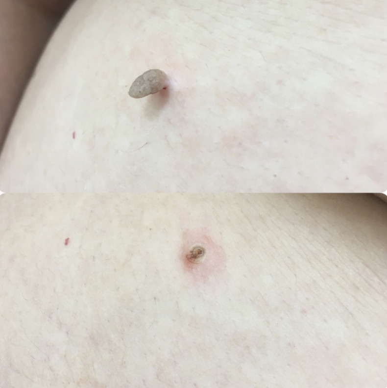 Удаление новообразований кожи, фото - Дерматолог косметолог Алёна Неделева