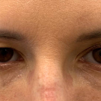 Лазерная блефаропластика
                    Медицинский центр Аура Киев