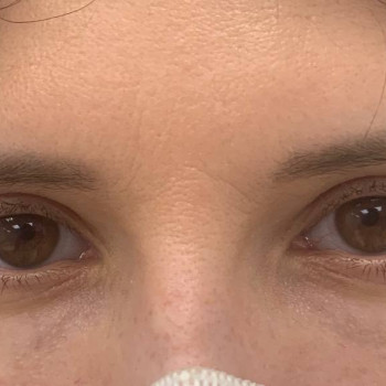 Лазерная блефаропластика
                    Медицинский центр Аура Киев