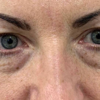 Лазерная блефаропластика
                    Медицинский центр Аура Киев