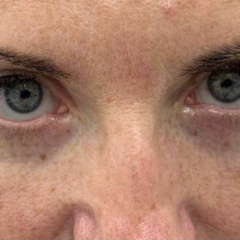 Лазерная блефаропластика
                    Медицинский центр Аура Киев