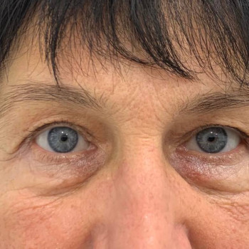 Лазерная блефаропластика
                    Медицинский центр Аура Киев