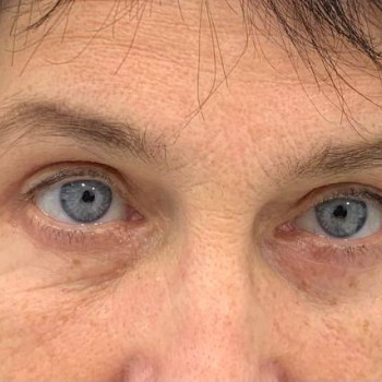 Лазерная блефаропластика
                    Медицинский центр Аура Киев