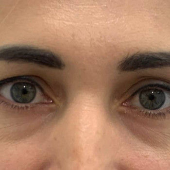 Лазерная блефаропластика
                    Медицинский центр Аура Киев